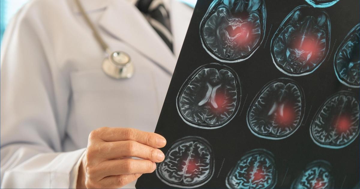 Инструкция по восстановлению: как после инсульта вернуться к привычной жизни (Психология) Инструкция по восстановлению: как после инсульта вернуться к привычной жизни (Психология)